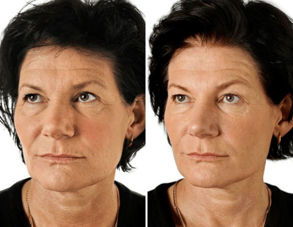 Výsledok frakčného omladenia tváre