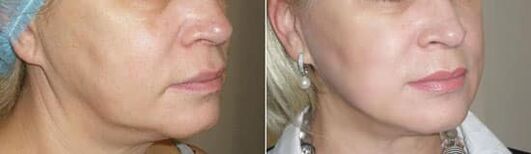 Foto po použití postupu