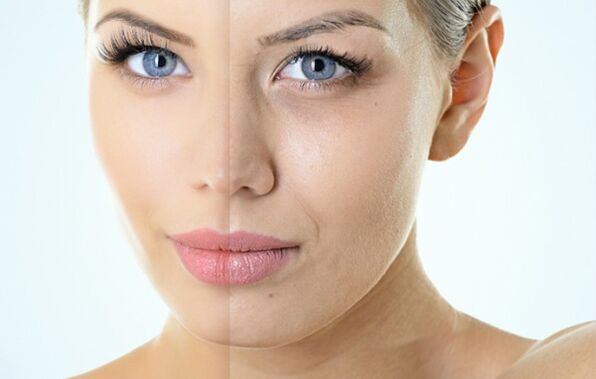 Indikácie pre frakčné omladenie