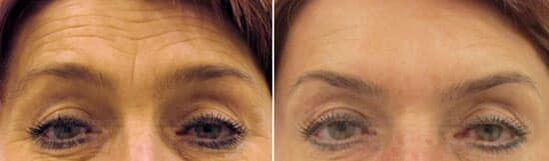 Omladenie poľa na čele